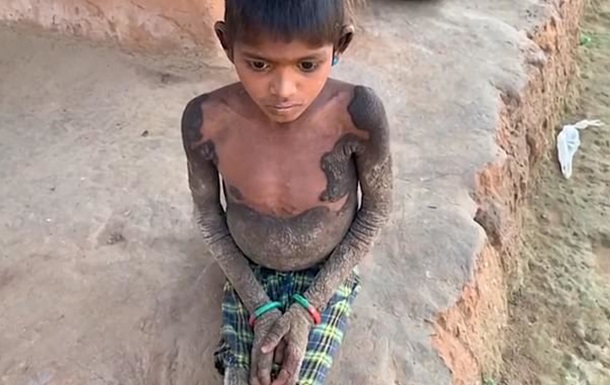 В Индии ребенок "окаменел" из-за редкой болезни - (видео)